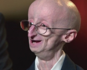 Progeria (erken yaşlanma) hastalığı nedir?