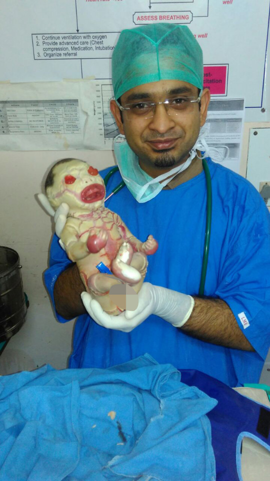 NAGPUR, INDIA - JUNE 12: A female infant affected by Harlequin ichthyosis, a severe genetic disorder, was born with almost no skin on her body on June 12, 2016 in Nagpur, India. Harlequin ichthyosis is a very rare severe genetic skin disease, which causes thickening of the stratum corneum of the epidermis. In such cases, the child's whole body is encased in an 'armour' of thick white plates of skin, separated with deep cracks. PHOTOGRAPH BY Barcroft Images London-T:+44 207 033 1031 E:hello@barcroftmedia.com - New York-T:+1 212 796 2458 E:hello@barcroftusa.com - New Delhi-T:+91 11 4053 2429 E:hello@barcroftindia.com www.barcroftimages.com